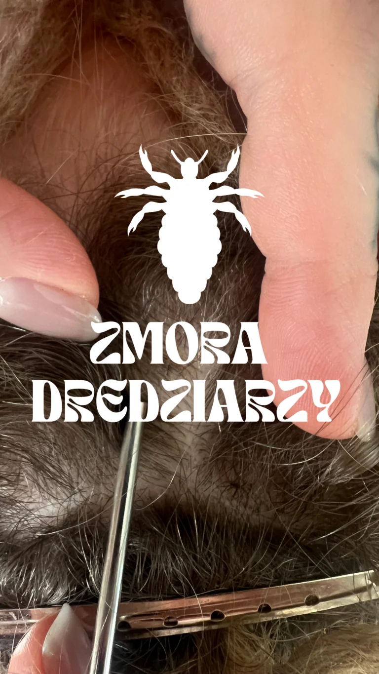 Wszy w dredach: co robić krok po kroku